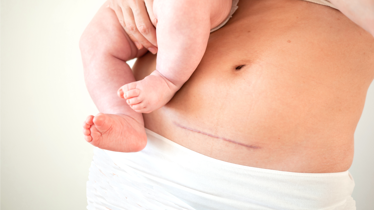 C-Section Recovery