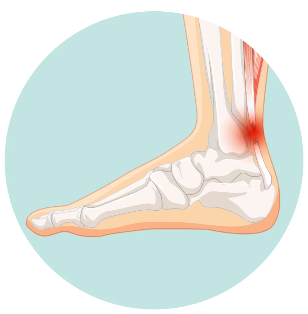 Capsulitis Treatment in Newmarket